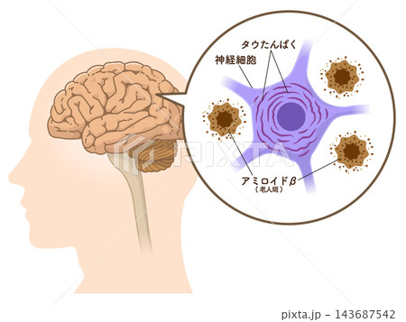 アルツハイマー病の脳 アミロイドβとタウたんぱく質 アルツハイマー病の脳 アミロイドβとタウたんぱく質 143687542