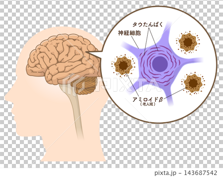 アルツハイマー病の脳 アミロイドβとタウたんぱく質 アルツハイマー病の脳 アミロイドβとタウたんぱく質 143687542