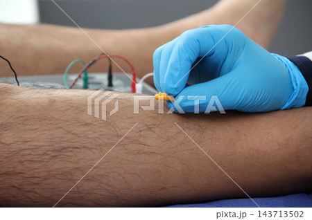 Electromyography in the lower limbs, graphic recording technique of the electrical activity produced by the tibial muscle performed by a specialist neurologist Electromyography in the lower limbs, graphic recording technique of the electrical activity produced by the tibial muscle performed by a specialist neurologist 143713502