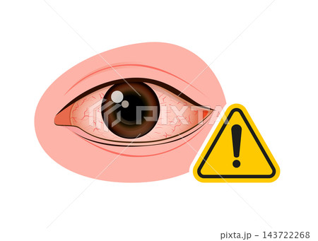 human eye showing redness and blood vessels with a warning symbol human eye showing redness and blood vessels with a warning symbol 143722268