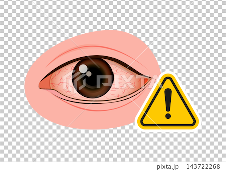 human eye showing redness and blood vessels with a warning symbol human eye showing redness and blood vessels with a warning symbol 143722268