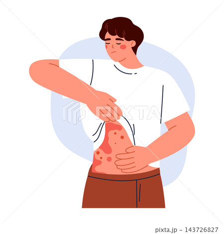 Man examining red allergic rashes on his abdomen and arm. Allergic reaction. Allergy, skin condition and dermatology concept. Vector illustration in cartoon style. Isolated on white background Man examining red allergic rashes on his abdomen and arm. Allergic reaction. Allergy, skin condition and dermatology concept. Vector illustration in cartoon style. Isolated on white background 143726827