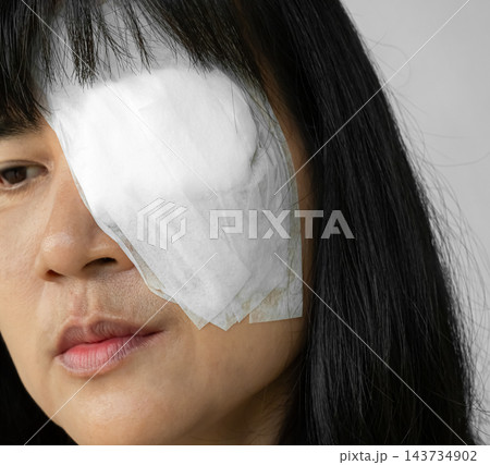 Pterygium surgery eye medical health, medicine care patient after pterygium excision of doctor oculist hospital, human problem vision disease lens iris from wind. Pterygium surgery eye medical health, medicine care patient after pterygium excision of doctor oculist hospital, human problem vision disease lens iris from wind. 143734902