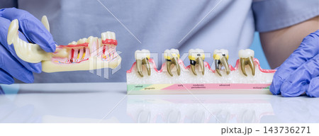 Dentist Demonstrating Stages of Periodontal Disease and Gingivitis Using Detailed Tooth and Gum Anatomy Models Dentist Demonstrating Stages of Periodontal Disease and Gingivitis Using Detailed Tooth and Gum Anatomy Models 143736271