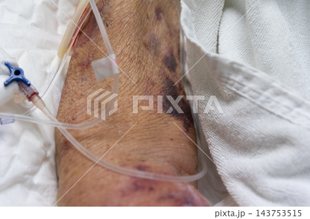 A close view of hospital patient arm shows purple bruising medical tubing transparent adhesive dressings beside white bedding visible skin texture around the taped treatment area 143753515
