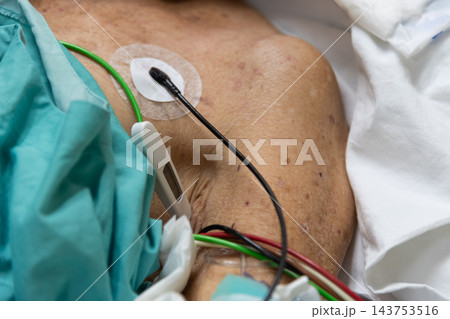 A hospital patient lies beneath green fabric adhesive monitoring electrodes wires attached to the chest while white bedding frames close view of clinical monitoring equipment A hospital patient lies beneath green fabric adhesive monitoring electrodes wires attached to the chest while white bedding frames close view of clinical monitoring equipment 143753516