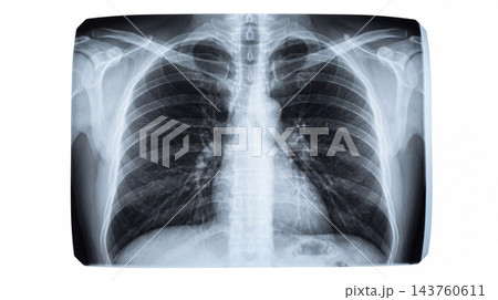 Chest X-ray Image of Human Lungs and Ribs for Medical Diagnosis 143760611