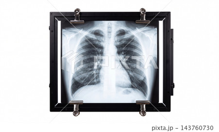 Human Chest X-ray Film on Diagnostic Light Box for Medical Examination 143760730