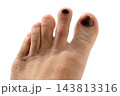 怪我で内出血の足爪 143813316