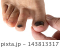怪我で内出血の足爪 143813317