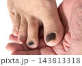 怪我で内出血の足爪 143813318