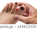 怪我で内出血の足爪 143813320