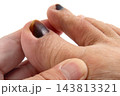 怪我で内出血の足爪 143813321