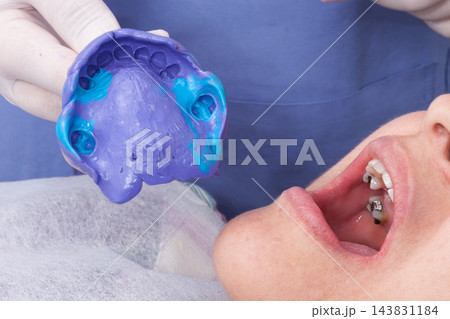 oral rehabilitation process, partial removable prosthesis 143831184