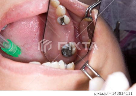 oral rehabilitation process, partial removable prosthesis oral rehabilitation process, partial removable prosthesis 143834111