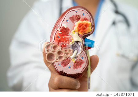 Chronic kidney disease, doctor with model for treatment urinary system, urology, Estimated glomerular filtration rate eGFR. Chronic kidney disease, doctor with model for treatment urinary system, urology, Estimated glomerular filtration rate eGFR. 143871071