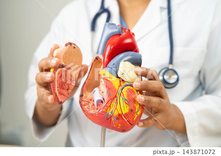 Cardiovascular disease CVD, doctor with heart human model anatomy for treatment patient in hospital. Cardiovascular disease CVD, doctor with heart human model anatomy for treatment patient in hospital. 143871072