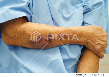 Ecchymosis, elderly bleeding on her arm after taking aspirin. 143871116