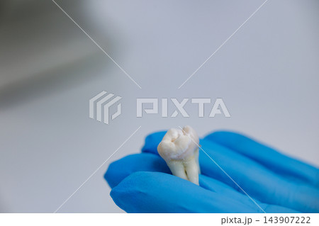 Close-up of a gloved hand holding an extracted molar with visible decay, illustrating dental treatment, tooth removal, and oral health education. Close-up of a gloved hand holding an extracted molar with visible decay, illustrating dental treatment, tooth removal, and oral health education. 143907222