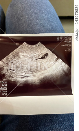 妊婦健診で受け取った妊娠初期の超音波写真 143970826