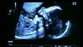 Baby yawning during Ultrasound scan (6 months) 15235803