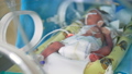 A skinny newborn baby connected to intensive care 37382569
