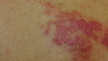 Herpes zoster skin disease caused  44195437